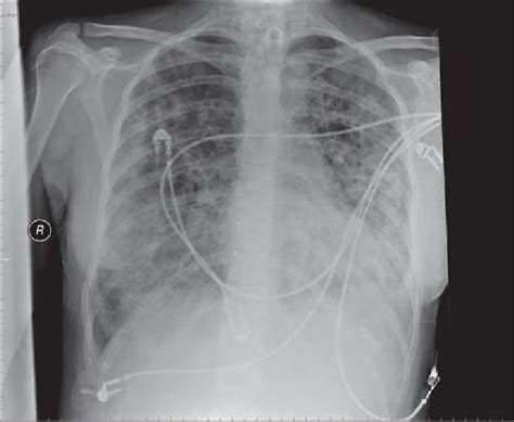 Ards Chest X Ray