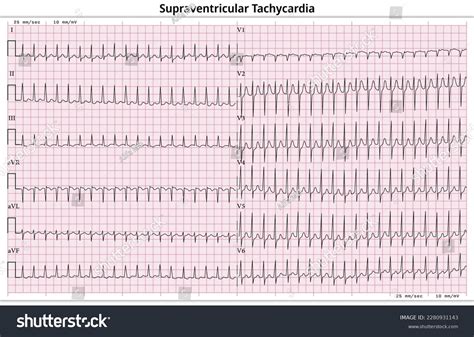 Ecg Supraventricular Tachycardia Svt 12 Lead Stock Vector (Royalty Free) 2280931143 | Shutterstock