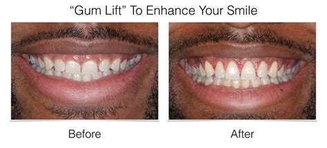 "Gum Lift" To Enhance Your Smile Philadelphia PA | Laudenbach Periodontics & Dental Implants