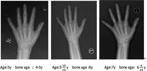 Age corresponds to changes in bone age. During the 6-month period from ...