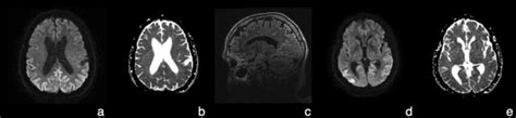 MRI of the patient’s brain at admission showing hyperintensity of the ...