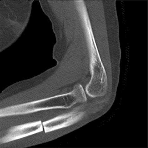 Sagittal image of computed tomography also shows cortical thickening... | Download Scientific ...