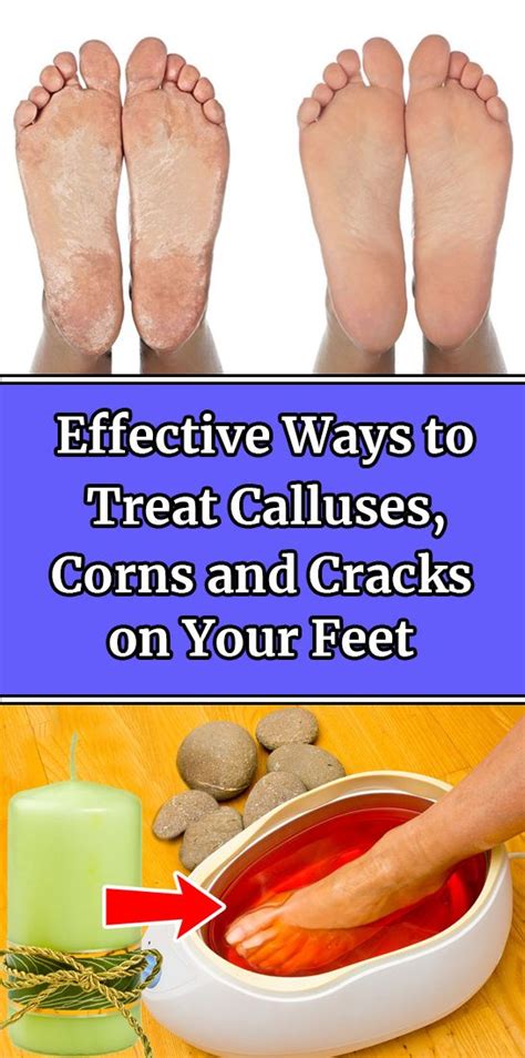 Effective Ways to Treat Calluses, Corns and Cracks on Your Feet | Health