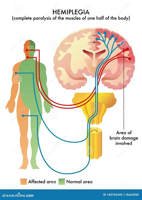 Hemiplegia Stock Illustrations – 18 Hemiplegia Stock Illustrations, Vectors & Clipart - Dreamstime