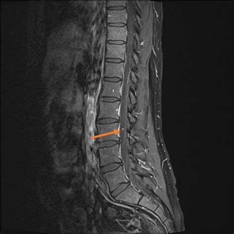Lumbosacral Spine MRI | Radiology Key