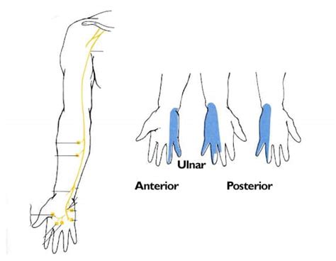 Cubital Tunnel Syndrome Treatment Without injection Or surgery