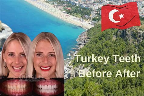Transform Your Smile with Turkey Teeth Before and After