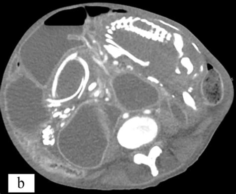 Lithopedion: Woman carries a stone child in her stomach for nine years - Archyde