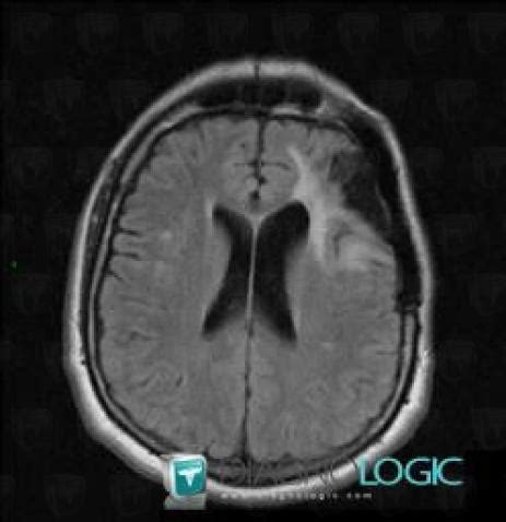 Radiology case : Gliosis (MRI ,CT) - Diagnologic