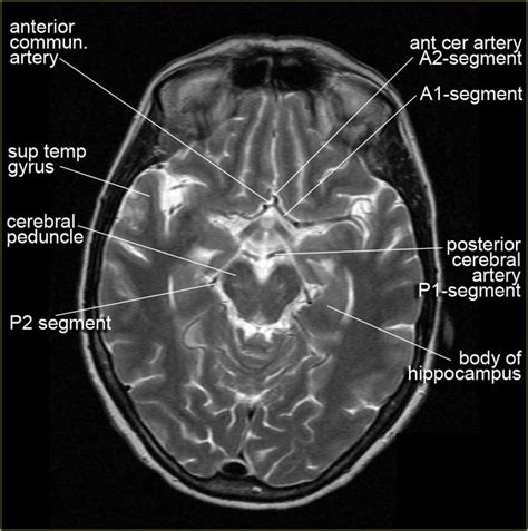 The Radiology Assistant : Brain Anatomy | Brain anatomy, Cranial nerves anatomy, Radiology