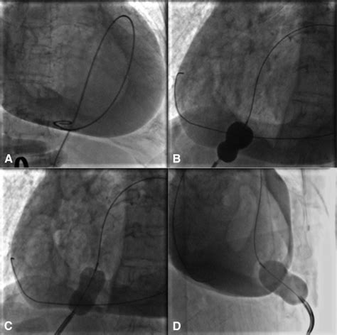 Percutaneous Balloon Pericardiotomy for Recurrent Malignant Pericardial Effusion - Journal of ...