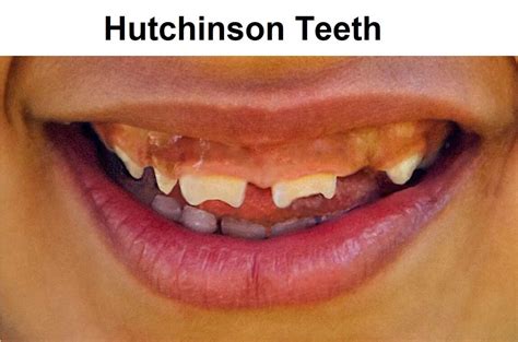 What are Hutchinson Teeth? | News | Dentagama