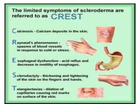 Progresive systemic sclerosis