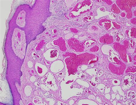 Verrucous Hemangioma Mimicking Melanoma in an Elderly Man