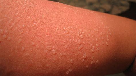 How to get Rid of Sunburn Blisters | sunburn treatment - YouTube