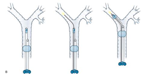 Separation of the Lung: Double-Lumen Endotracheal Tubes and Endobronchial Blockers | Anesthesia Key