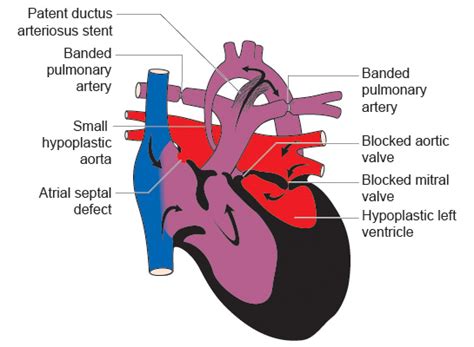 Hybrid Procedure – Hearts of Hope Australia