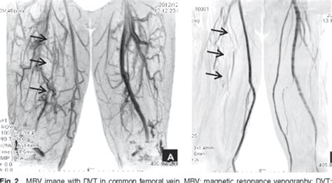 Figure 2 from MR Venography for the Assessment of Deep Vein Thrombosis ...