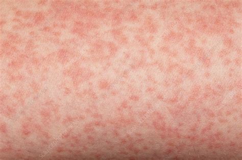 Scarlet fever - Stock Image - C023/4294 - Science Photo Library