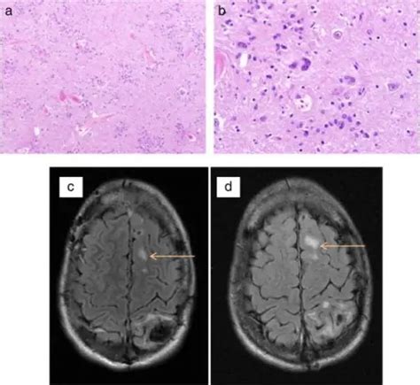 What is Neurofibromatosis Type 2? - Pathosomes