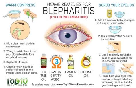 Blepharitis: Home Remedies & Self-Care Measures - eMediHealth | Blepharitis, Remedies, Home remedies