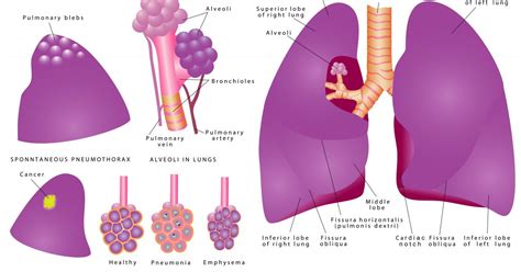 Spontaneous Pneumothorax: Things to… | Counseling | Therapy