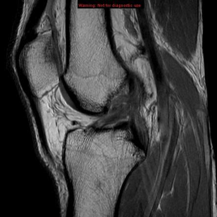 Anterior Cruciate Ligament Mri