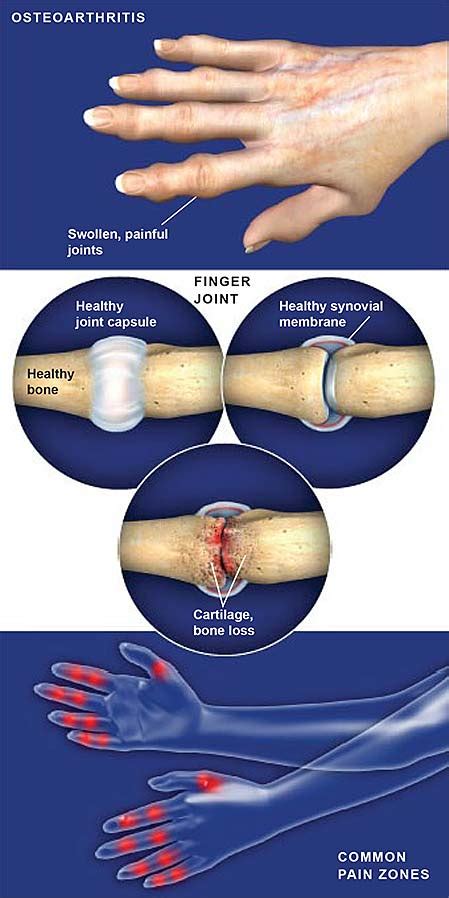 Osteoarthritis of the Hand | Central Coast Orthopedic Medical Group