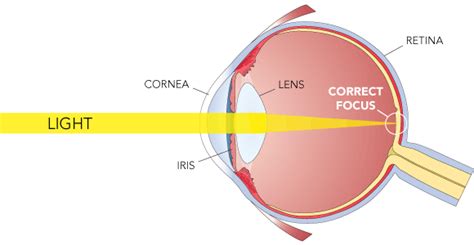 Refractive Errors