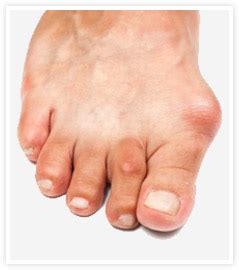 Natural Gout Treatment Support - Best Uric Acid Supplements