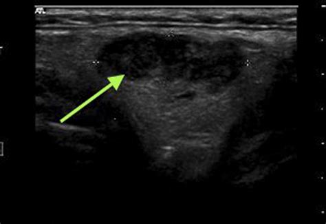 What Does Lipoma Look Like On Ultrasound | Sitelip.org