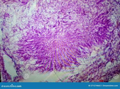 Vocal Cord Actinomycosis with Sulfur Granules in Tissue Stock Image ...