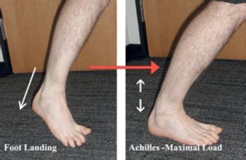 Achilles Tendon Rupture - Sports Clinic NQ