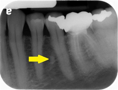 Retained deciduous root fragment – Dr. G's Toothpix