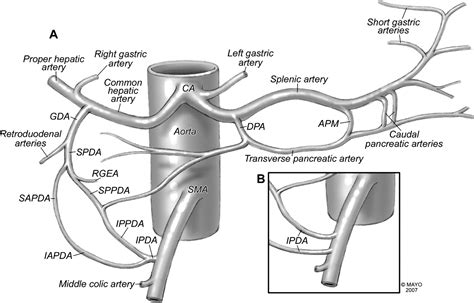 Celiac Artery Stenosis: An Underappreciated and Unpleasant Surprise in Patients Undergoing ...