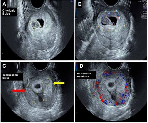 Cureus | Chorionic Bump: Radiologic Features and Pregnancy Outcomes