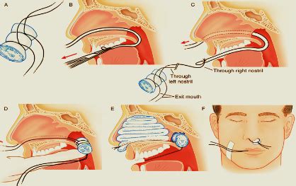 Best Nose Specialist in Mumbai - Dr. Meenesh Juvekar