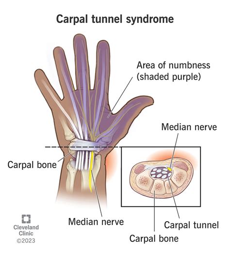 Carpal Tunnel Syndrome: Symptoms, Causes & Treatment