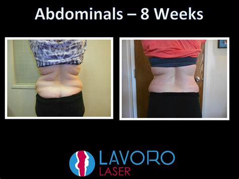 Before & After Gallery | Walnut Creek, CA | Lavoro Laser