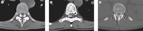 Spontaneous Spinal Cerebrospinal Fluid Leaks and Intracranial Hypotension | Neurology | JAMA ...