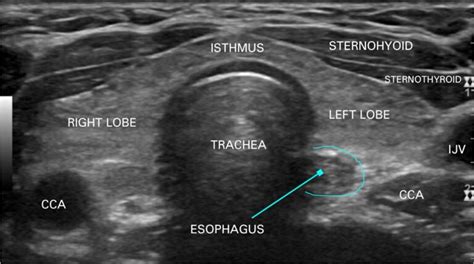 Normal Thyroid Ultrasound Images - MyEndoConsult