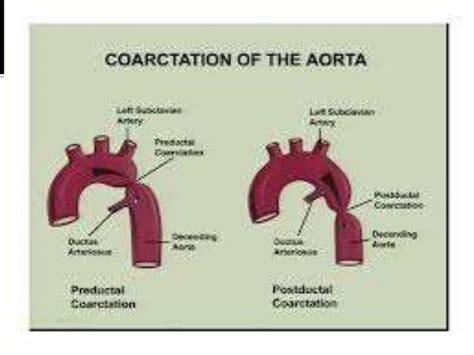 Coarctation of aorta