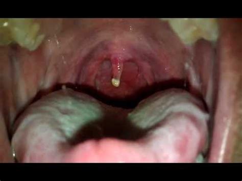 My uvula hurts day 5 - YouTube