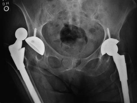 Medical Apparatus Imaging Guide: joint arthroplasty