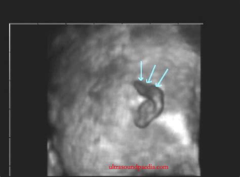 Microtia – Anotia – ULTRASOUNDPAEDIA