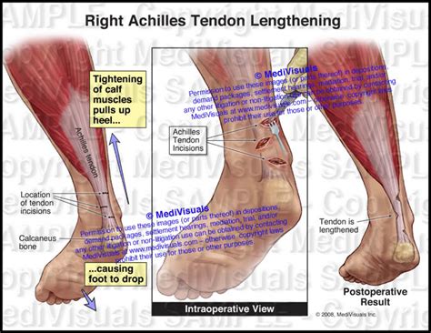 Achilles Tendon Lengthening - Medivisuals Inc.