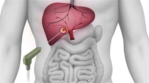 CAMC in Charleston, WV, offers microwave ablation for liver cancer | WV News | wvnews.com