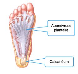 Aponévrose plantaire, fasciite plantaire - SOS PIED CHEVILLE