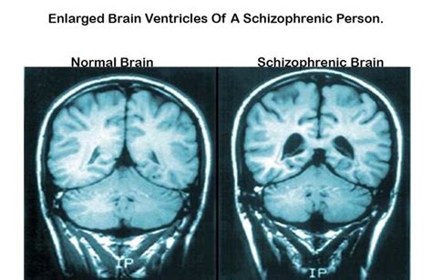 9 Common Myths About Schizophrenia You Probably Thought Were True | LifeDaily