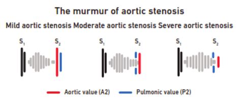 Aortic Stenosis Murmur